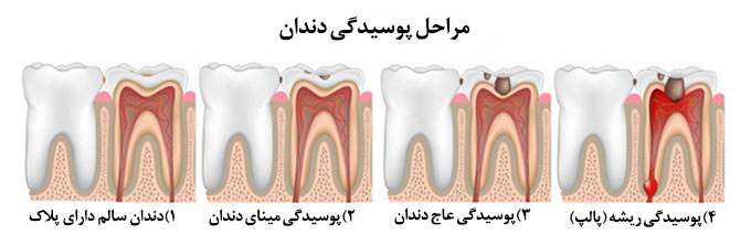 tooth decay